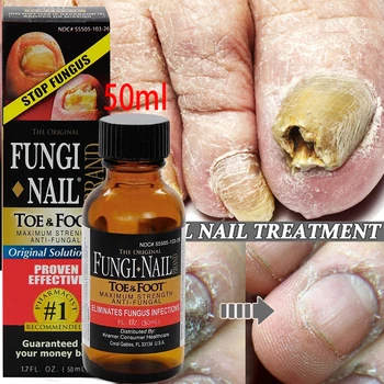 Fungicidní ošetření nehtů, podstatu řešení, opravy gelu, péče o nohy léčbu nehet houba Odstranění Gelu, nehet houba léčba